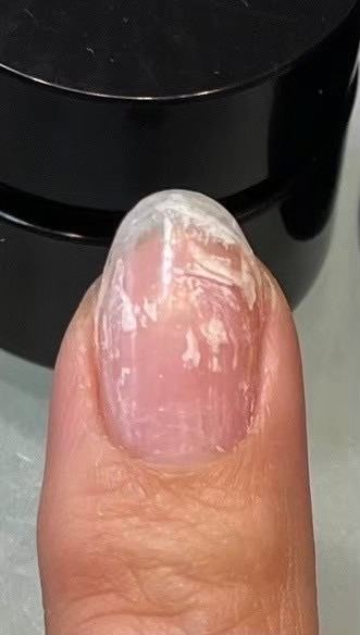 先が欠けて重なった爪